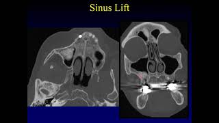 Imaging of the Paranasal Sinuses 5 [upl. by Otanod]