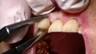 Physics Forceps Informational Video 2013  Golden Dental Solutions [upl. by Burnham383]