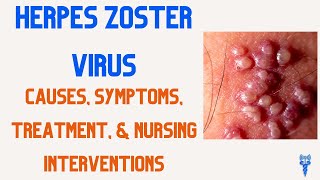 HERPES ZOSTER Symptoms Causes Treatment amp Nursing Interventions [upl. by Imyaj]