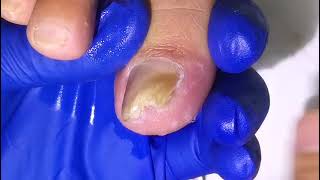 The straight toenails are also embedded  decompression  pedicure  obsessivecompulsive disorder [upl. by Hterag]