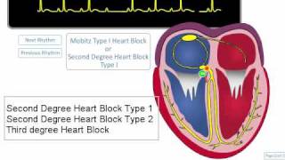 ECG Rhythm Review AV Blocks [upl. by Eblehs]