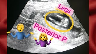 13 weeks oregnant gender reveal  posterior placenta means baby boygirl  how to tell gender on usg [upl. by Cirederf]