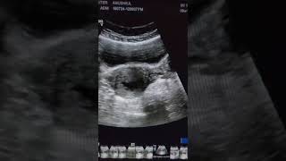 subchorionic hemorrhage video ultrasound pregnant scan video [upl. by Tehcac686]