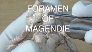 FORAMEN OF MAGENDIE [upl. by Suiradal]