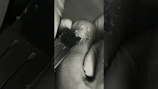 Ingrown toenail removal with Pedicure Knife Cut it easily Ep360 [upl. by Anas924]