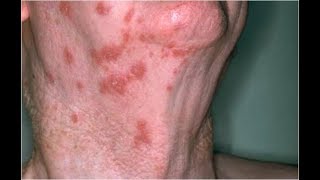 How Long Is Shingles Contagious Shingles Vaccine Cost Herpes Zoster ContagiousShingles Contagious [upl. by Barnes48]