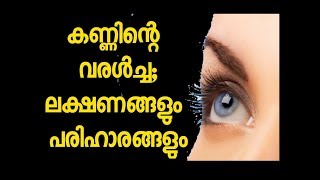 Dry eyes symptoms and Remedies Malayalam Tips കണ്ണിന്‍റെ വരള്‍ച്ച അപകടമോ [upl. by Aikcin]