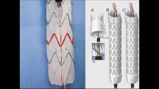 Dr Gustavo Oderich  Physician Modified Fenestrated Endografts Technical Aspects and Outcomes [upl. by Yentruoc]