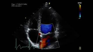 Pulmonary Stenosis [upl. by Salvatore]