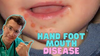 How to recognise amp treat Hand Foot and Mouth Disease Coxsackievirus in kids  Doctor ODonovan [upl. by Katushka]