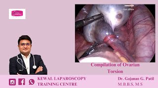 Ovarian Torsion by Dr Gajanan Patil  Kewal Hospital  Laparoscopy Training [upl. by Audrey]