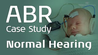 ABR Case Study Normal Hearing [upl. by Fortunato]