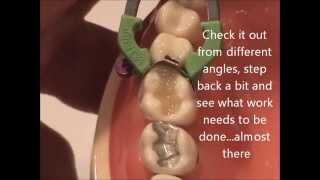 Maxillary Composite Placement WREB [upl. by Marthena]