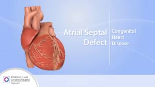 Heart Conditions – Atrial Septal Defect ASD [upl. by Abdella]