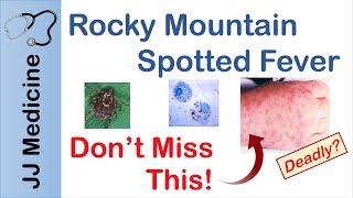 Rocky Mountain Spotted Fever  Bacteria Signs amp Symptoms Diagnosis and Treatment [upl. by Marcelle612]