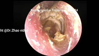 ear wax removal extractionEndoscopic management of cholesteatoma [upl. by Attela270]