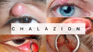 Chalazion  Ophthalmology  EASY MBBS [upl. by Lleoj]