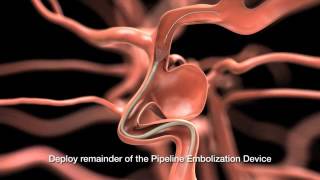 Akım yönlendirici stent ile anevrizma tedavisi [upl. by Mariska]