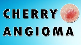 Cherry Hemangioma Symptoms Treatment and Causes [upl. by Coridon]