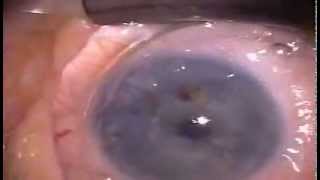 PROKERA® for Recurrent Corneal Erosion [upl. by Reamy230]