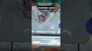 Ovarian cyst  histopathology ovariancyst cyst  ovariancancer histology [upl. by Ikilisav]