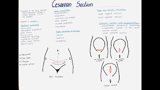 Cesarean Section  Types Indications Incisions etc [upl. by Llerdna]