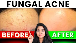 🔴 Are Those Little Bumps Fungal Acne Heres the Fast Easy Solution to Smoothing Your Skin Again [upl. by Euqinahc]