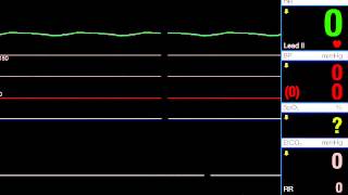 Asystole [upl. by Hgieliak]