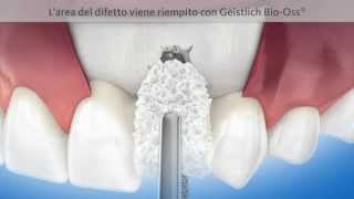 Formazione di osso intorno ad un impianto dentale  Geistlich Biomaterials [upl. by Akisej]