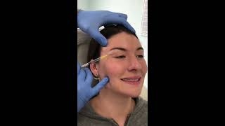 Dysport Injections for a Brow Lift with Dr Sean Paul  Austin Oculofacial Plastics [upl. by Ennad]