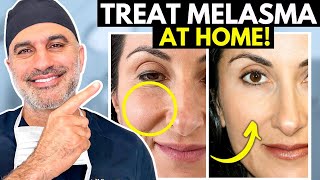 What you NEED to know about treating Melasma AT HOME the RIGHT way [upl. by Henri]