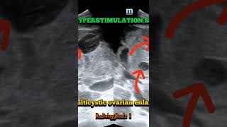 Ovarian Hyperstimulation syndrome fy fypyoutube study fypシ fypage foryou trending radiology [upl. by Lengel]