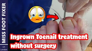 Ingrown Toenail Treatment Without Surgery By Miss Foot Fixer [upl. by Alaek]