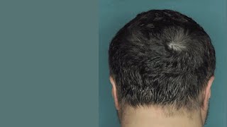 Drug Restores Hair Growth in Patients with Alopecia Areata [upl. by Wolk]