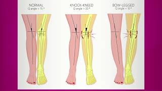 Bowlegs and Knockknees in Children [upl. by Allan]