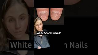 White Spots On Nails Explained dermatologist [upl. by Snilloc706]