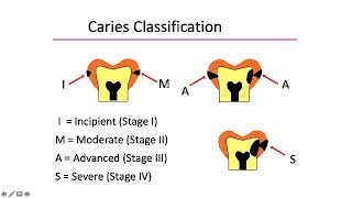 Diagnosis of Dental Caries part 2 Prof Dr Talal AlNahlawi د طلال النحلاوي [upl. by Taber867]