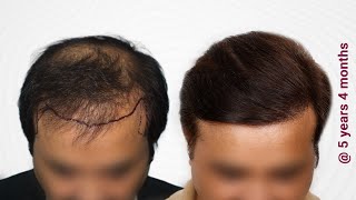 Epic Transformation Through Hair Transplant [upl. by Suedama]