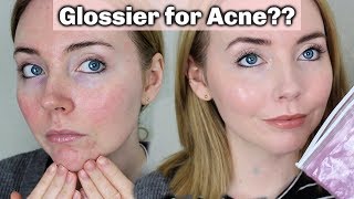 Glossier for Acne Prone Skin  Does it Work My Tips [upl. by Yuji249]