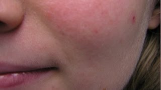 Rosacea  What causes it [upl. by Violet79]