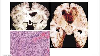 TUMORS Of CNS  Gliomas Astrocytoma  Oligodendroglioma  Midline Glioma  Ependymoma [upl. by Driscoll]