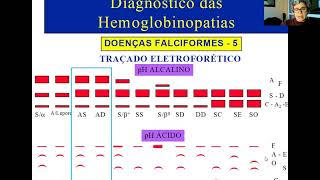 Aula Diagnóstico Hemoglobinopatias [upl. by Auqenehs792]