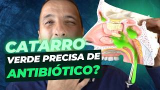 CATARRO VERDE PRECISA UTILIZAR ANTIBIÓTICO [upl. by Accebber]