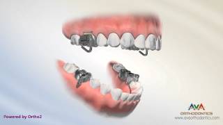 Orthodontic Treatment for Overjet Overbite  MARA Appliance [upl. by Carter]