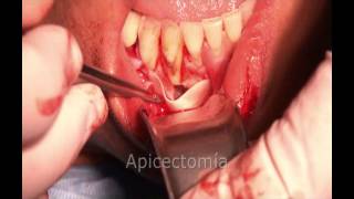 master en periodoncia implantología oral IVIO [upl. by Guild]