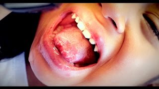 BAD TONGUE SORES Herpes Stomatitis  Dr Paul [upl. by Asecnarf99]