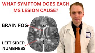 What Symptom Does Each Multiple Sclerosis MRI Lesion Cause Neurologist Explains [upl. by Prowel]