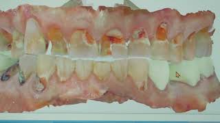 All On Four Dental Implants Denver Co  Case Study OG Dental [upl. by Stucker487]