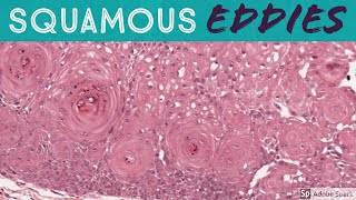 Irritated Seborrheic Keratosis w Squamous Eddies 5Minute Pathology Pearls [upl. by Nalorac191]