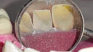 Anterior teeth preparation  U1 by  Ahmed Adnan Albhaisi [upl. by Tuddor]